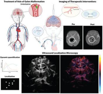 Ultrasound Localization Microscopy bei Vena Galeni Malformation